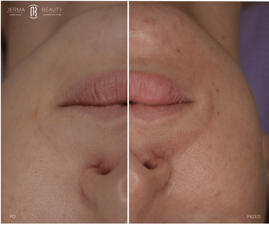 zaczerwieniania skóry